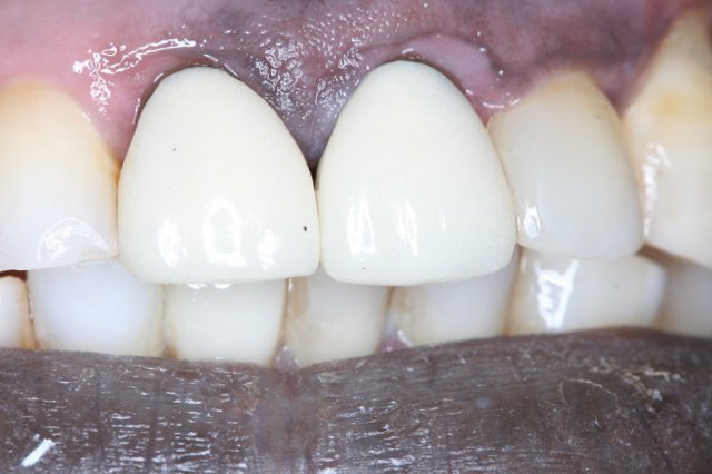 Crowns Before